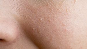 Việc trị mụn cho da khô thường rất khó khăn