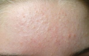 Da mụn ẩn là tình trạng da đang bị tổn thương từ sâu bên trong nang lông 