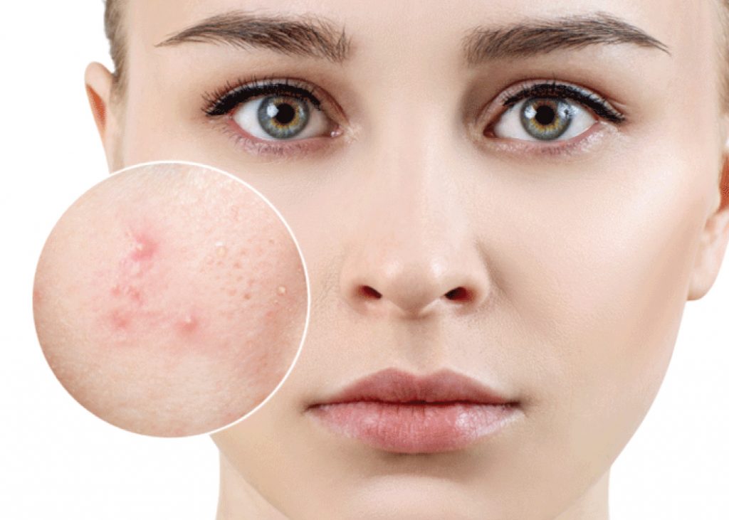 Có thể bạn đang tự hỏi vậy chính xác da mặt mình thuộc loại da gì, da mụn là da như thế nào?