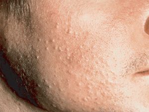 Những bạn sở hữu làn da khô rất dễ gặp tình trạng da mặt sần sùi nhiều mụn cám