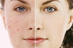 Mỹ phẩm trị thâm mụn ưa chuộng nhất thị trường hiện nay 13 my pham tri tham mun