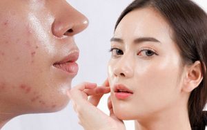 sản phẩm trị mụn tốt nhất hiện nay