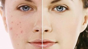 Mỹ phẩm trị thâm mụn tốt nhất hiện nay bạn có thể chưa biết 2 Mỹ phẩm trị thâm mụn tốt nhất hiện nay bạn có thể chưa biết