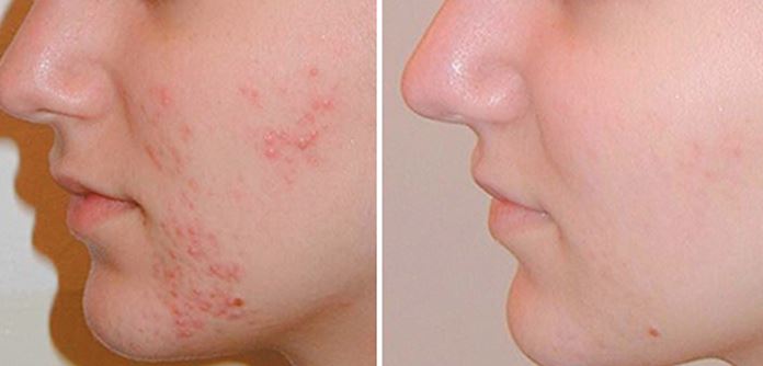 Mụn là nỗi đau của rất nhiều người và luôn được quan tâm nhiều nhất