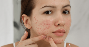 Top những sản phẩm trị mụn tốt nhất được các bạn trẻ yêu thích