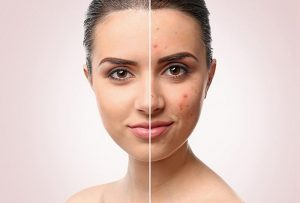 5 Lưu ý khi khi dùng kem dưỡng trắng da trị mụn 1 Những dòng kem dưỡng trắng da trị mụn đang được săn đón nhất thị trường