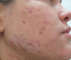 Mụn thâm là tình trạng vùng da tổn thương do mụn, bị thay đổi màu sắc vốn có ban đầu và chuyển sang màu tối, còn gọi là vết thâm