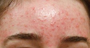 Thế nào là da mụn và da mụn phải làm sao?