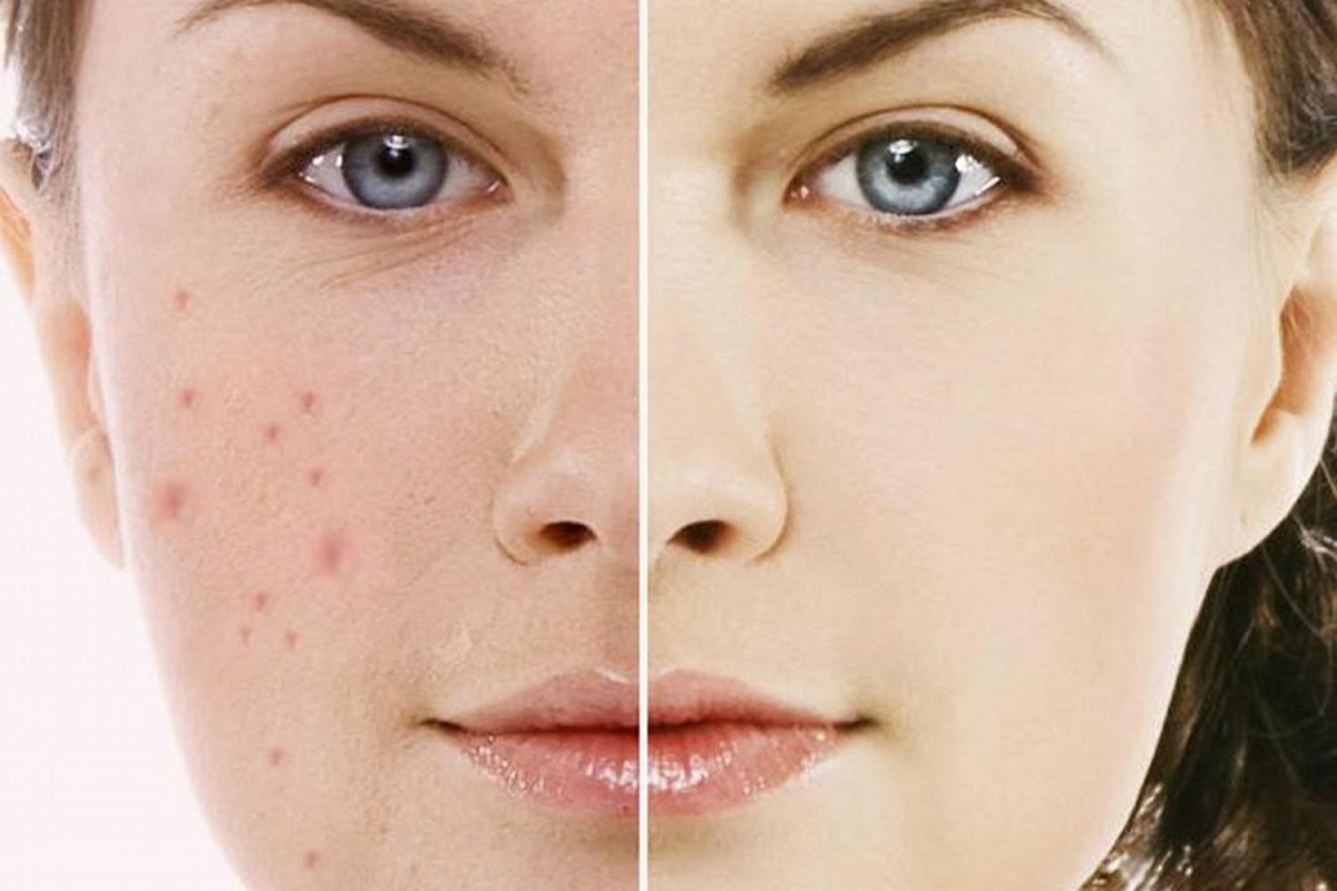 Nguyên nhân nào dẫn đến tình trạng thâm mụn?