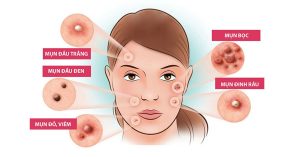 Các loại mụn thường gặp và thành phần trị mụn hiệu quả bạn nên biết