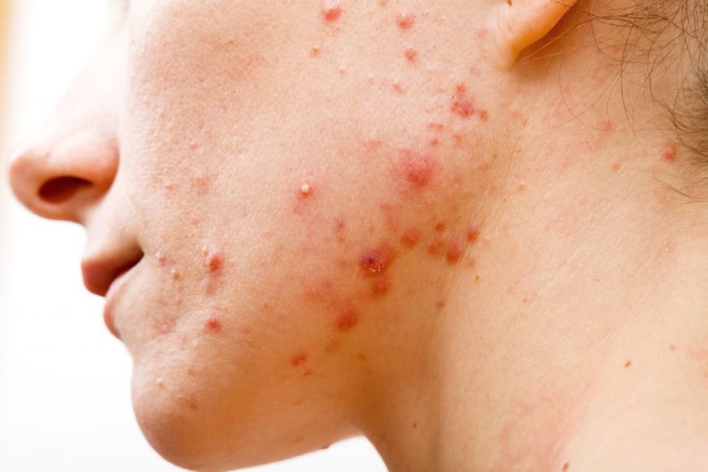 Những Điều Cần Lưu Ý Khi Chăm Sóc Da Bị Mụn Viêm 4 Viêm da mụn mủ là tình trạng không hiếm gặp đặc biệt và với thời tiết oi bức như hiện tại