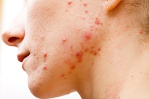 Những Điều Cần Lưu Ý Khi Chăm Sóc Da Bị Mụn Viêm 7 Viêm da mụn mủ là tình trạng không hiếm gặp đặc biệt và với thời tiết oi bức như hiện tại