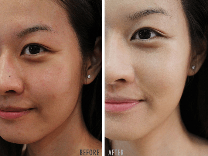 Retinol là thành phần chính có mặt trong các sản phẩm làm sạch mụn từ nhiều thành phần tổng hợp