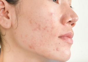 Serum trị mụn là sản phẩm dành cho da mụn với khả năng làm sạch mụn và ngừa mụn quay trở lại