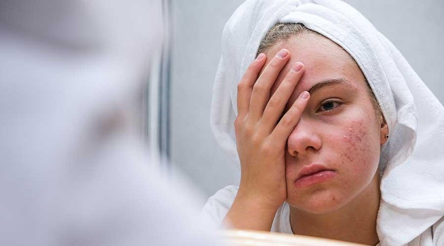 Tuyệt chiêu xử lý mụn sưng viêm 2 Mun sung viem gay anh huong den tham my lan da