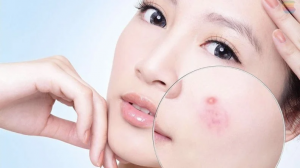 Tuyệt chiêu xử lý mụn sưng viêm 1 mun sung viem