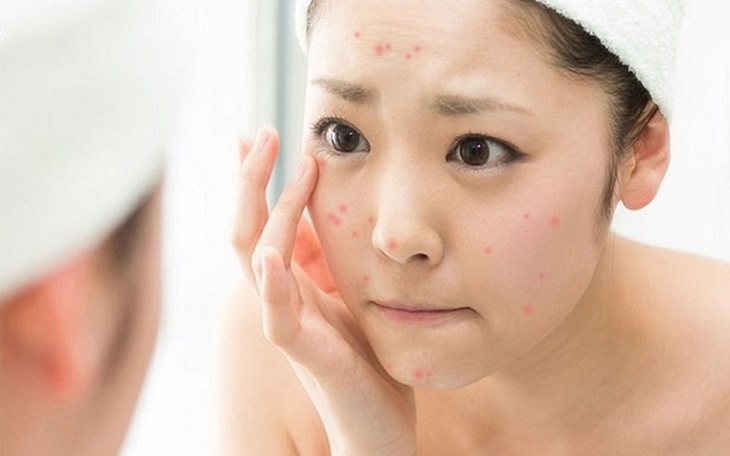 Những mỹ phẩm dành cho tuổi dậy thì khi bị mụn
